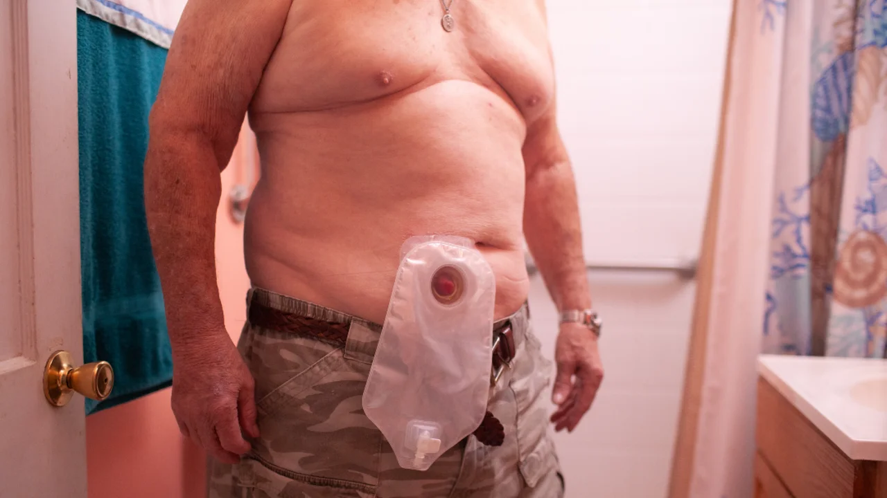 A picture of a person wearing an ostomy bag.